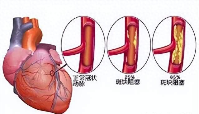 冠状动脉球囊扩张图片