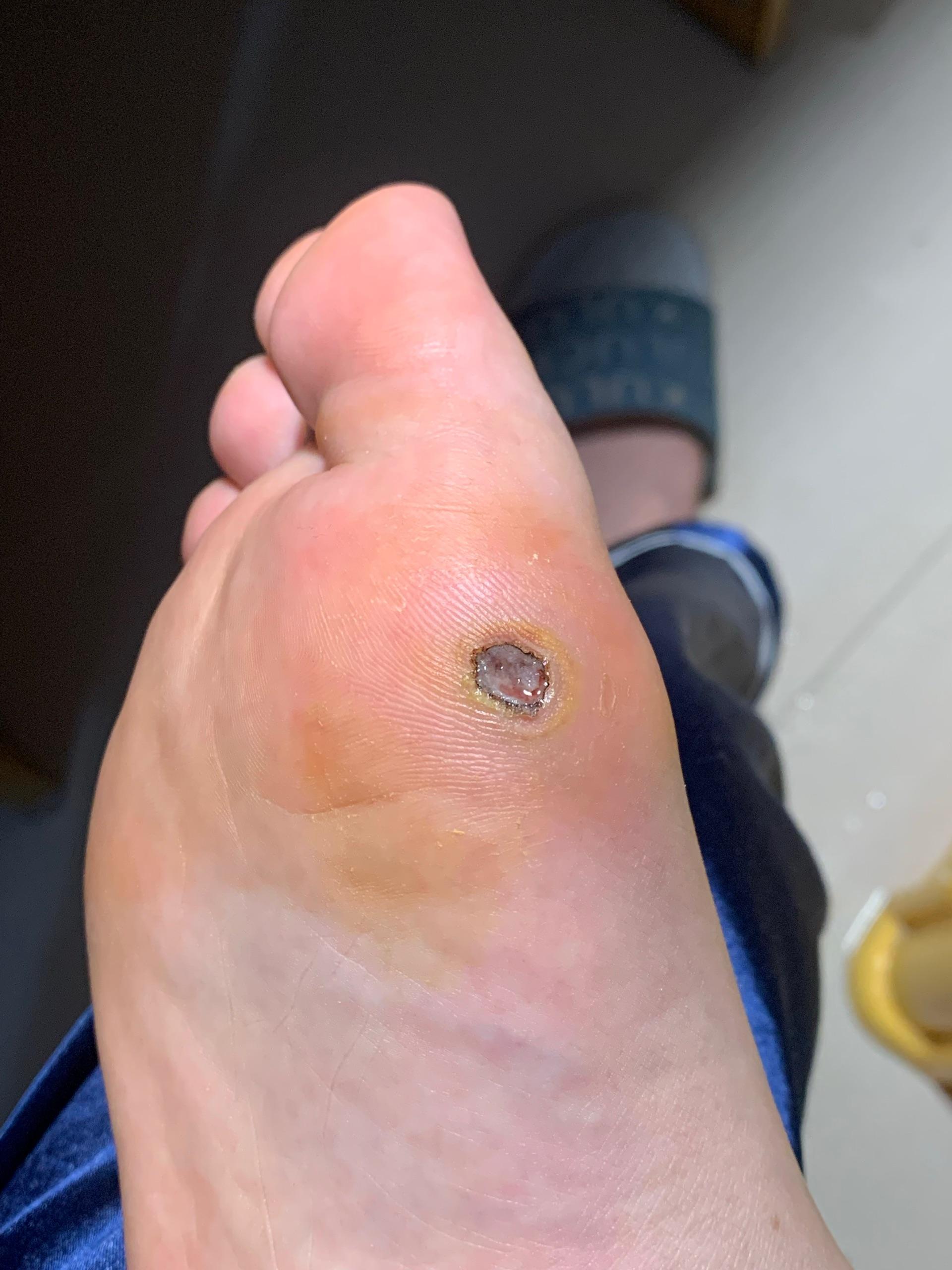 鸡眼怎么彻底挖出? - 知乎