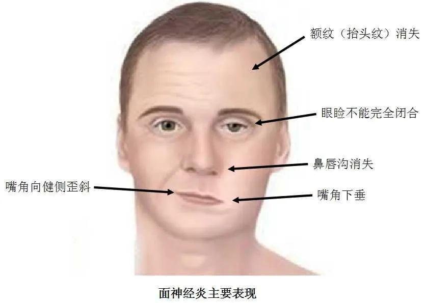 特发性面瘫和贝尔麻痹，两者什么关系？ - 知乎