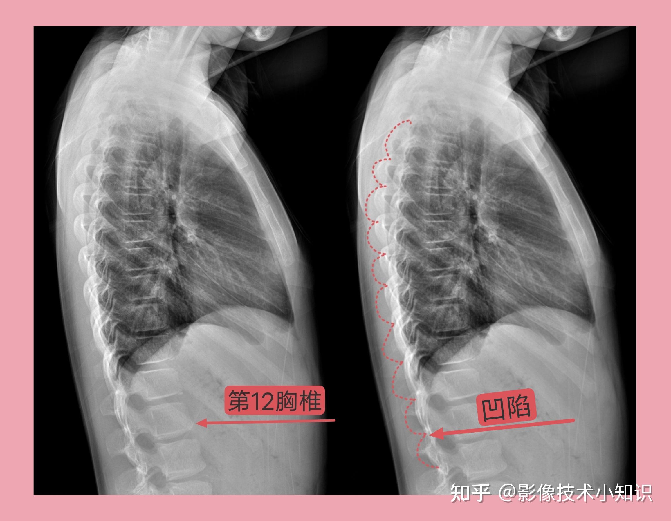 新手看胸椎ct片图解图片