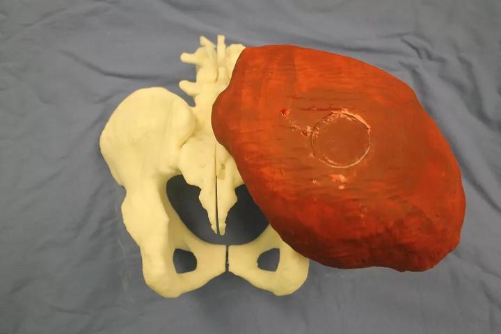 62岁男子盆骨肿瘤大如篮球  湘雅骨科运用"黑科技"6小时精准切除