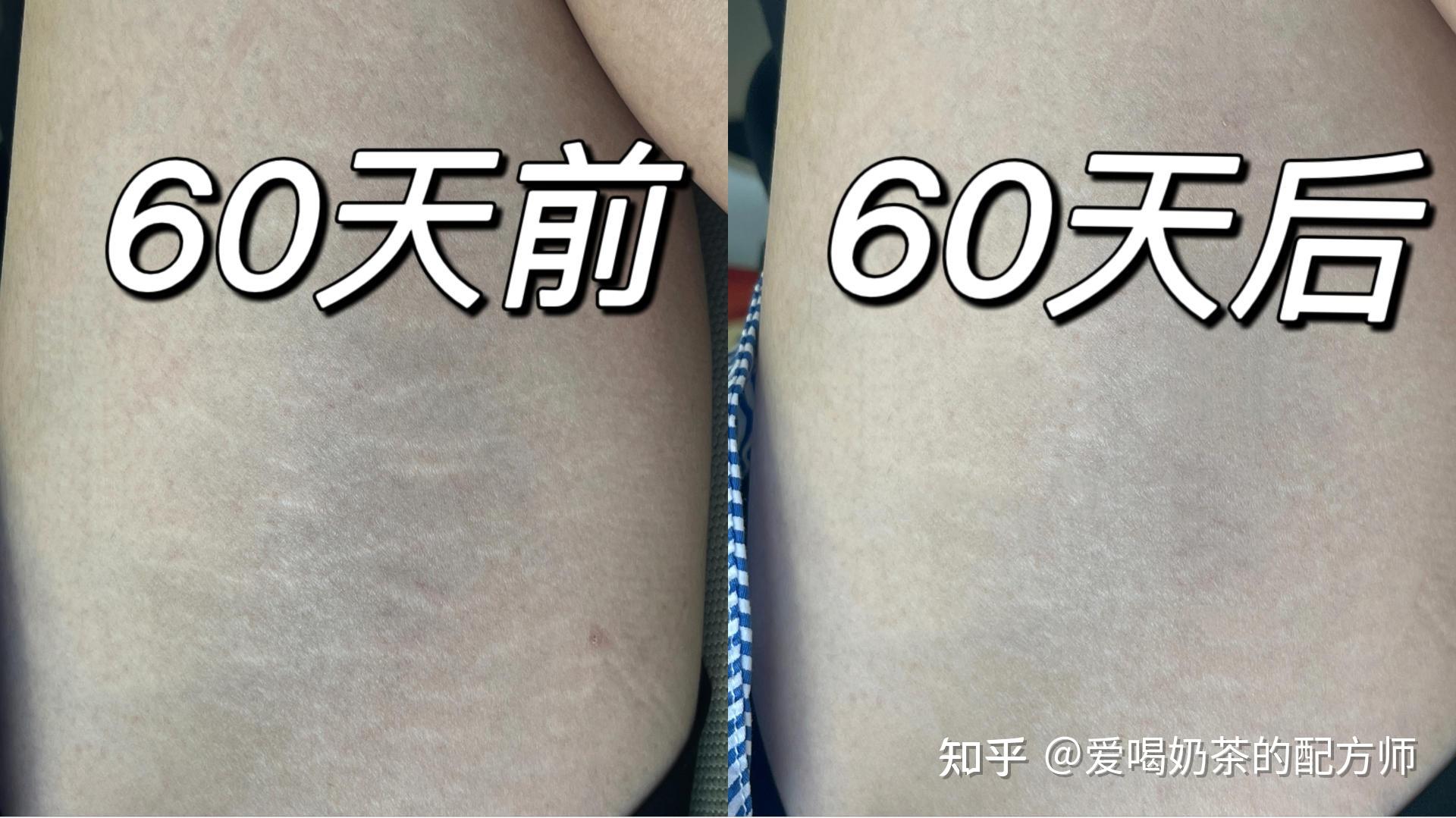 肥胖纹 瘦了会消失 嘛? - 知乎