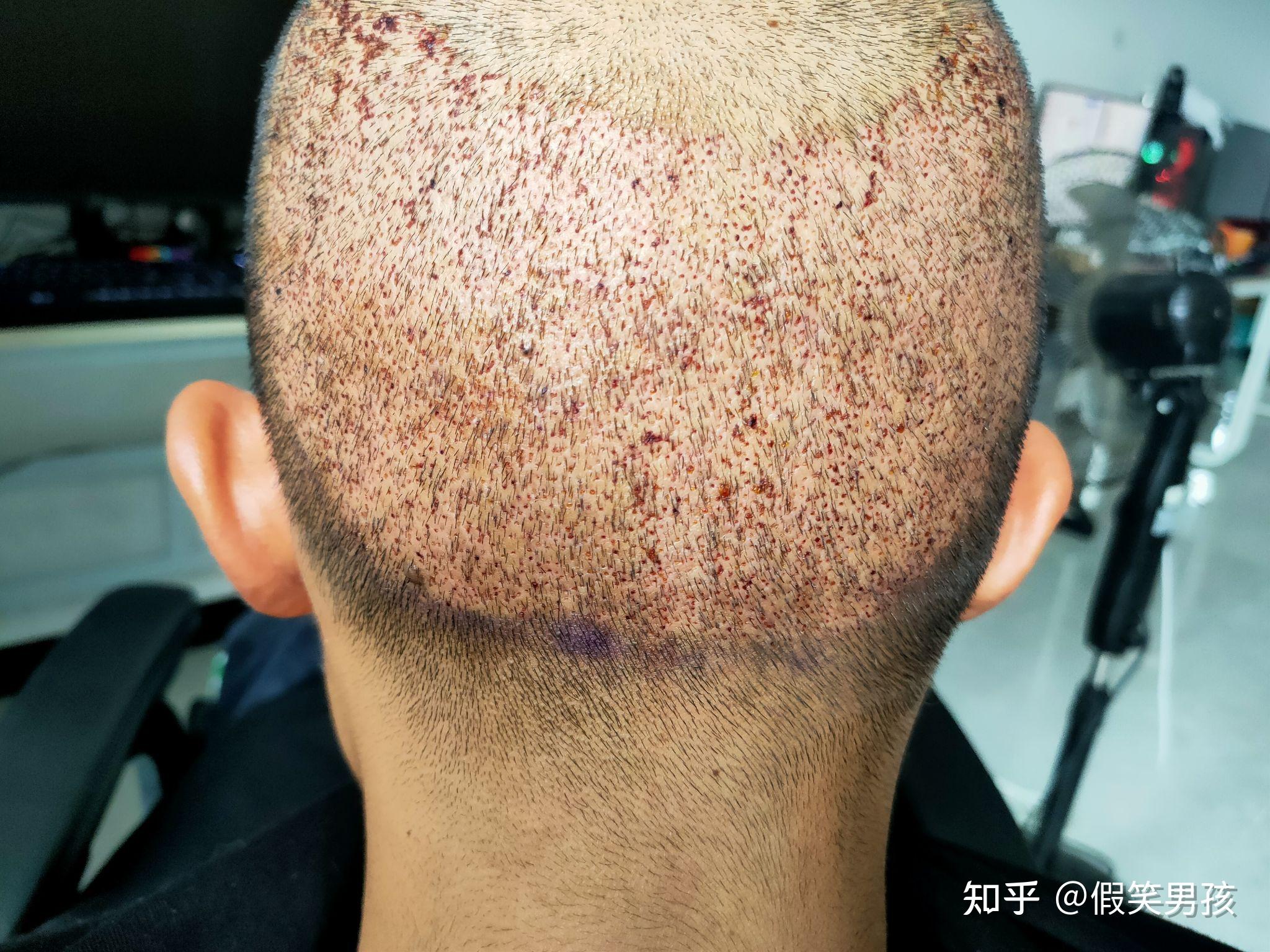 植发扣毛囊(植发毛囊抠掉的样子)