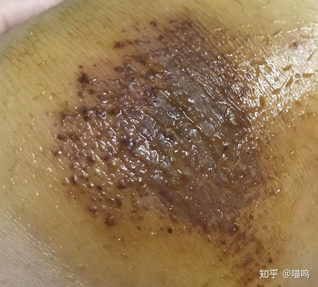 膝盖摔伤抹了碘伏结痂后如何防止留疤