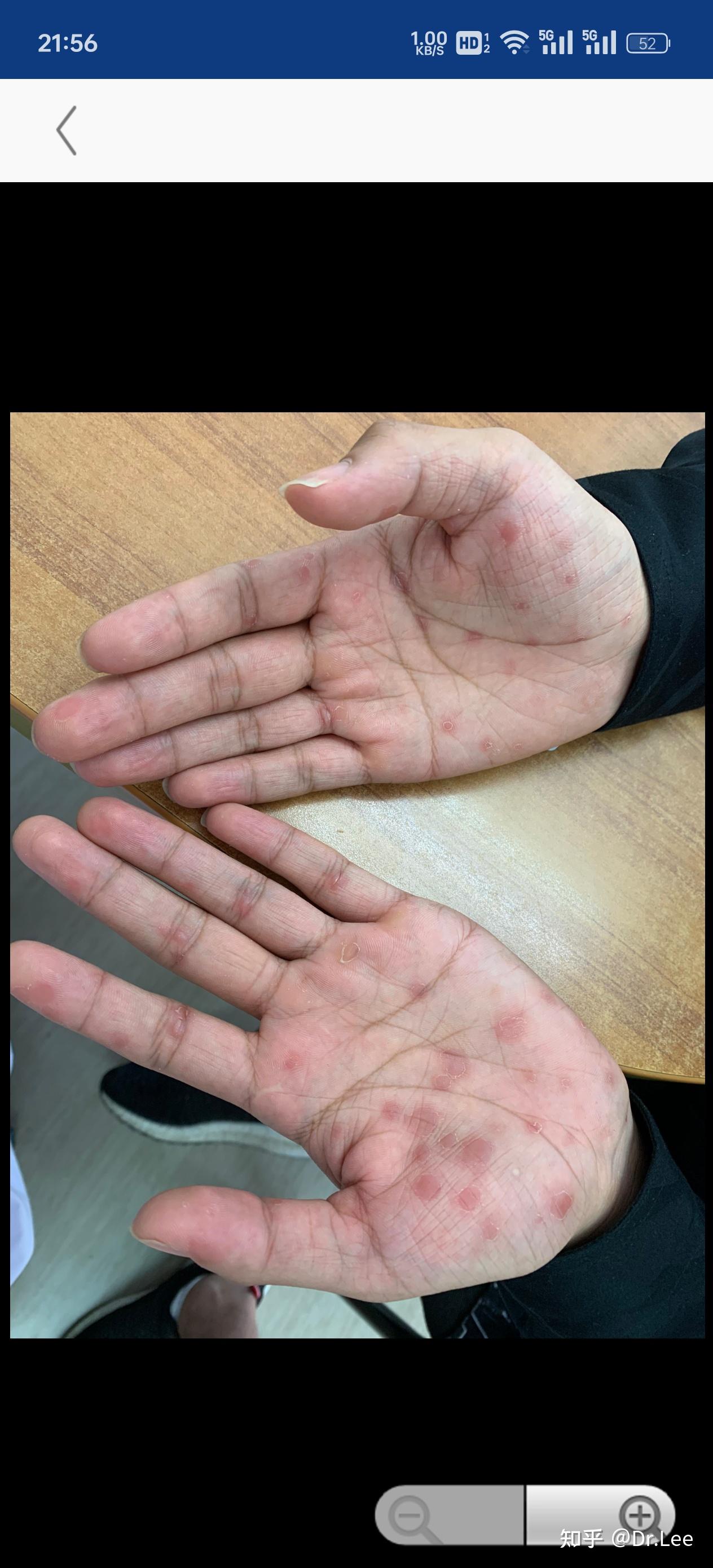 我这个是梅毒疹吗好害怕