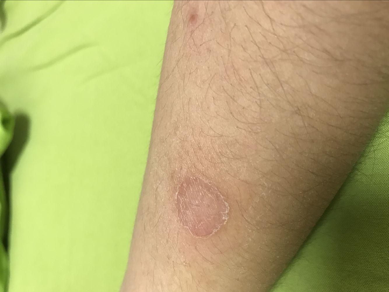 人如果得了猫癣怎么办