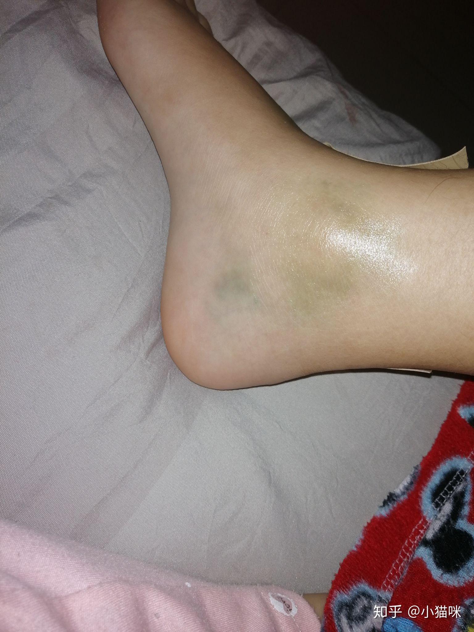 脚崴了怎么好得快? - 知乎