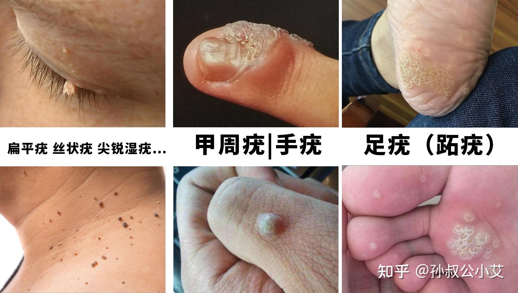 如何判断皮肤上出现的是疣? - 知乎