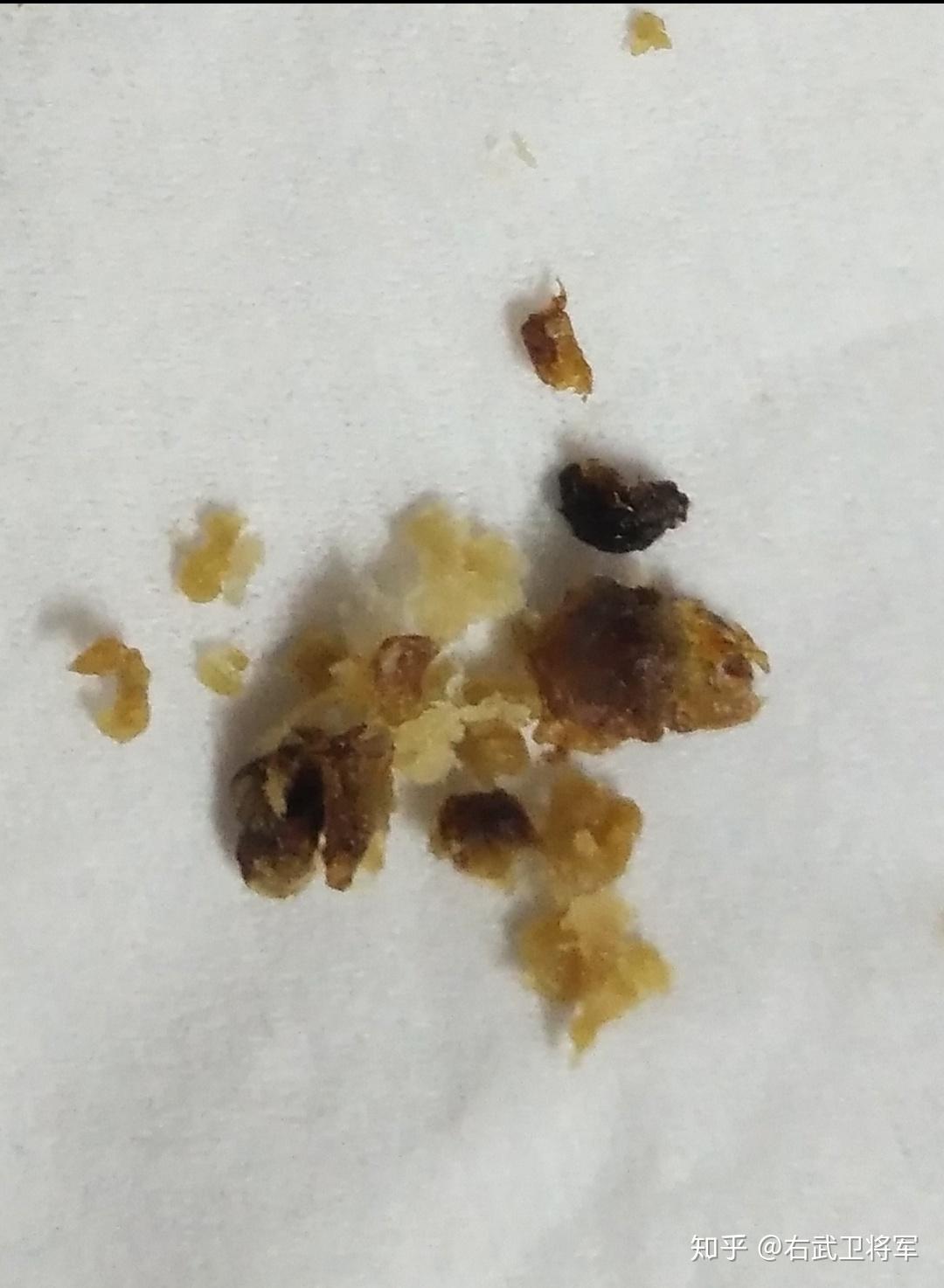 耳屎最大能有多大