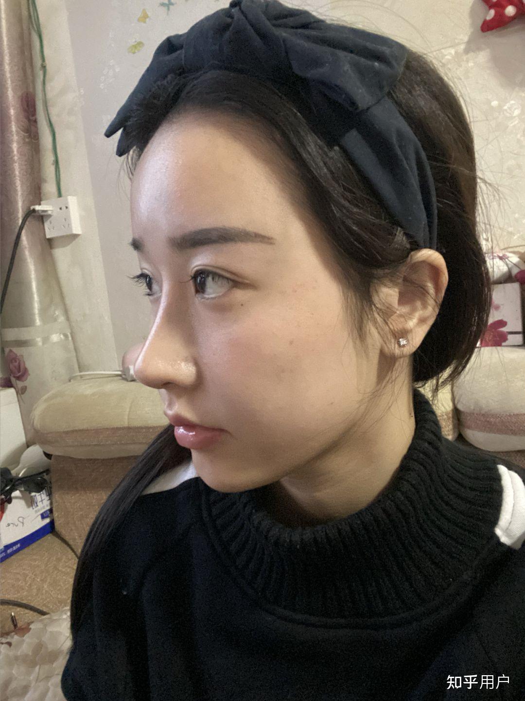 还有艺星的张龙鼻修复哪一位更适合做自然款的? - 知乎
