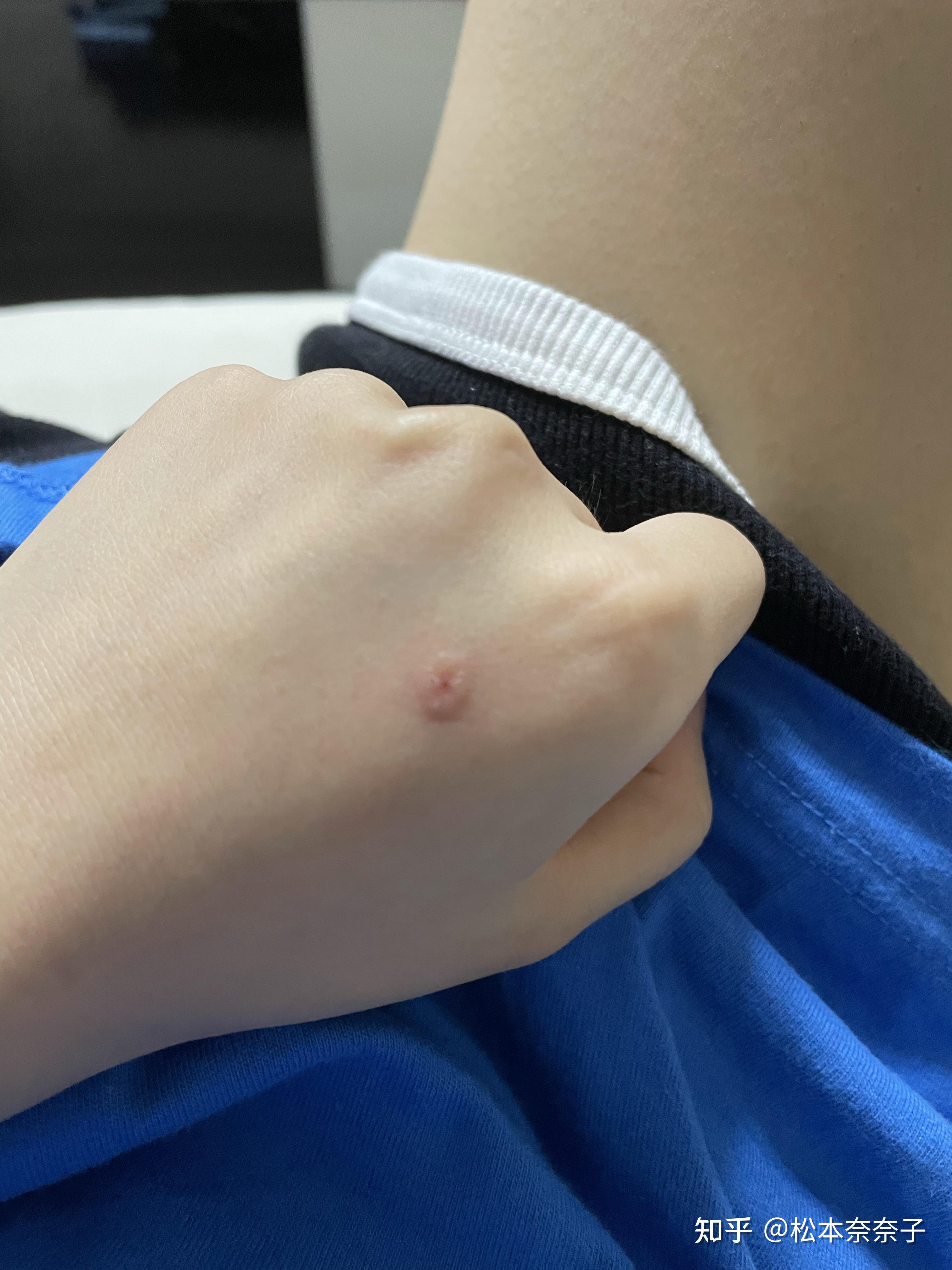 人长猫藓什么样子