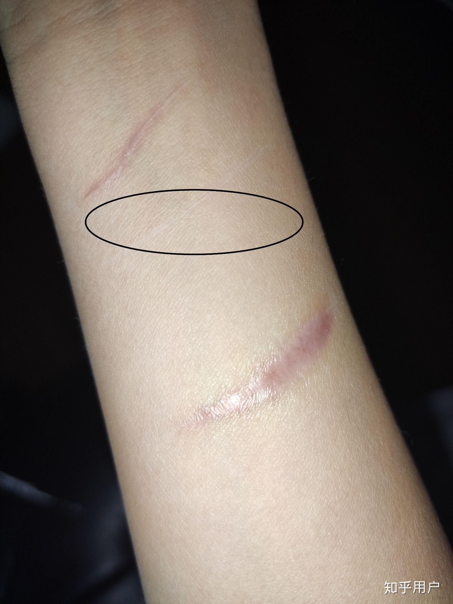 割腕的疤可以去掉吗