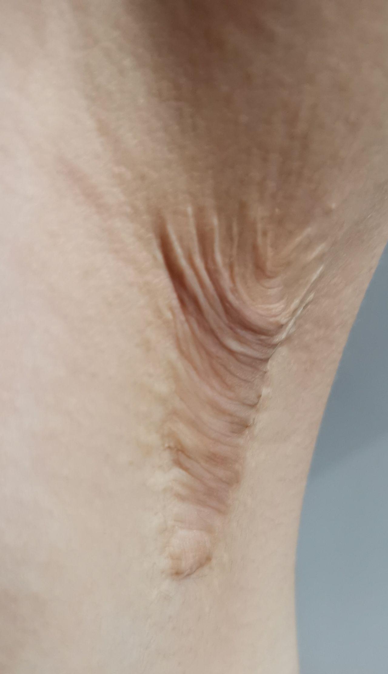 做腋下大汗腺切除手术是什么体验