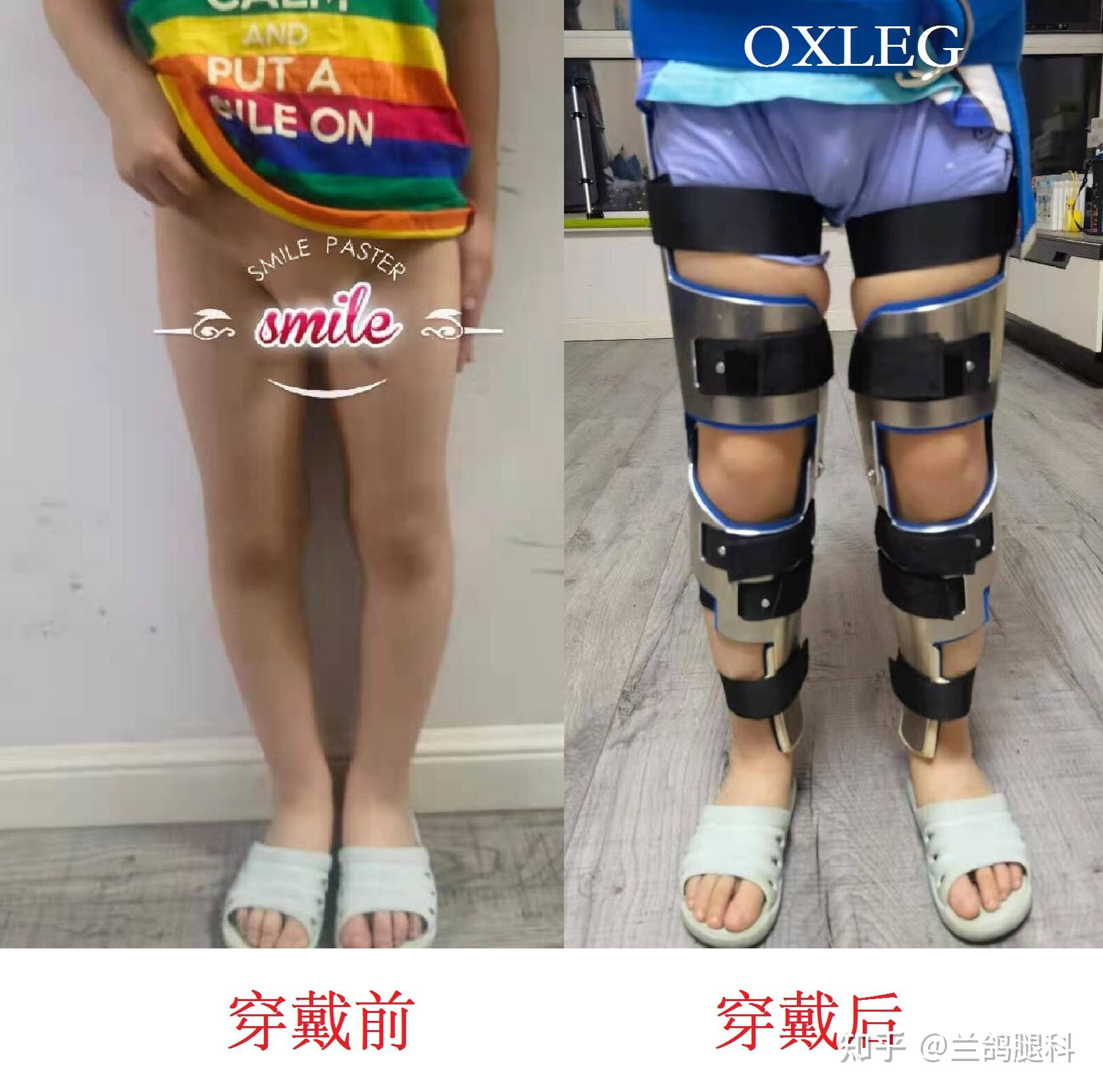 O型腿手术矫治（膝内翻病例）杨华清矫形骨科 - 好大夫在线