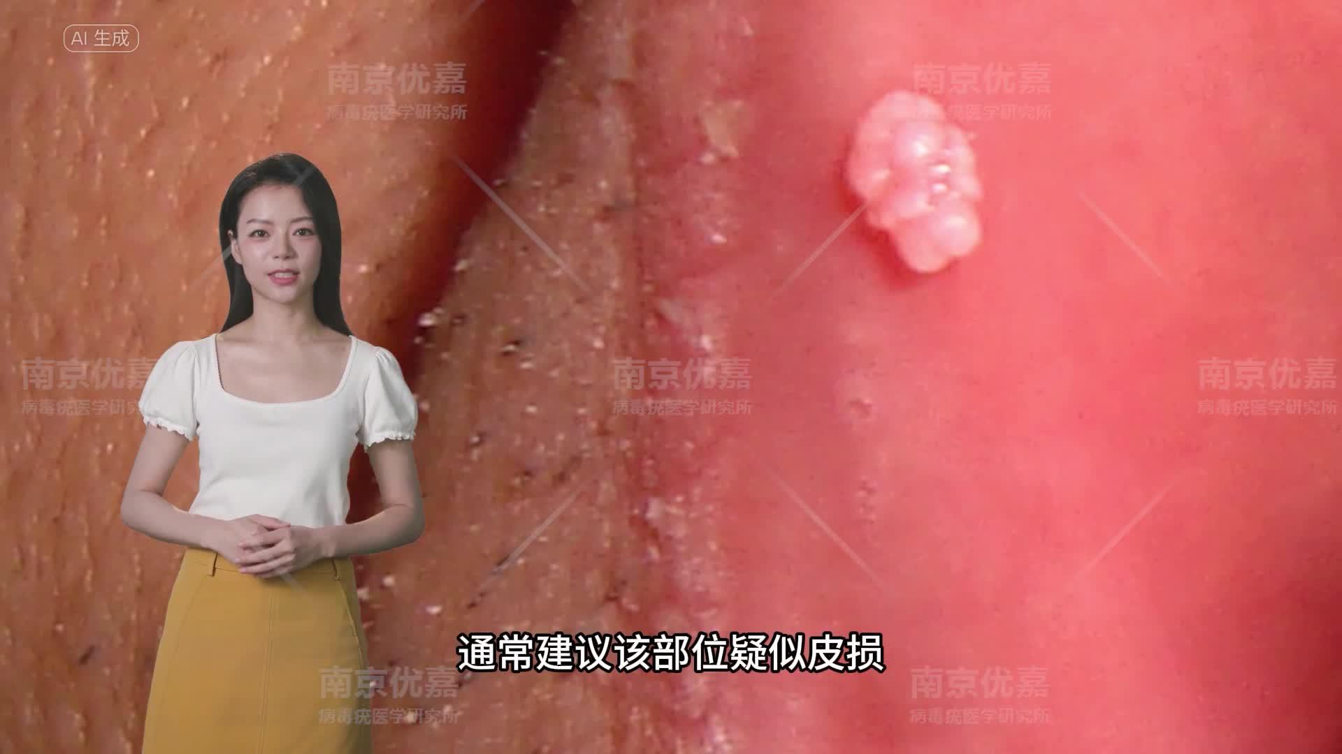 男性口腔尖锐湿疣症状图片