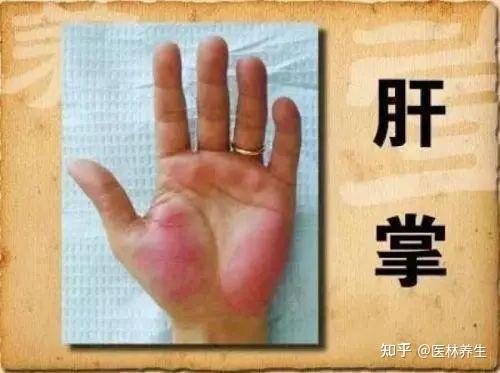 肝硬化有什么症状表现