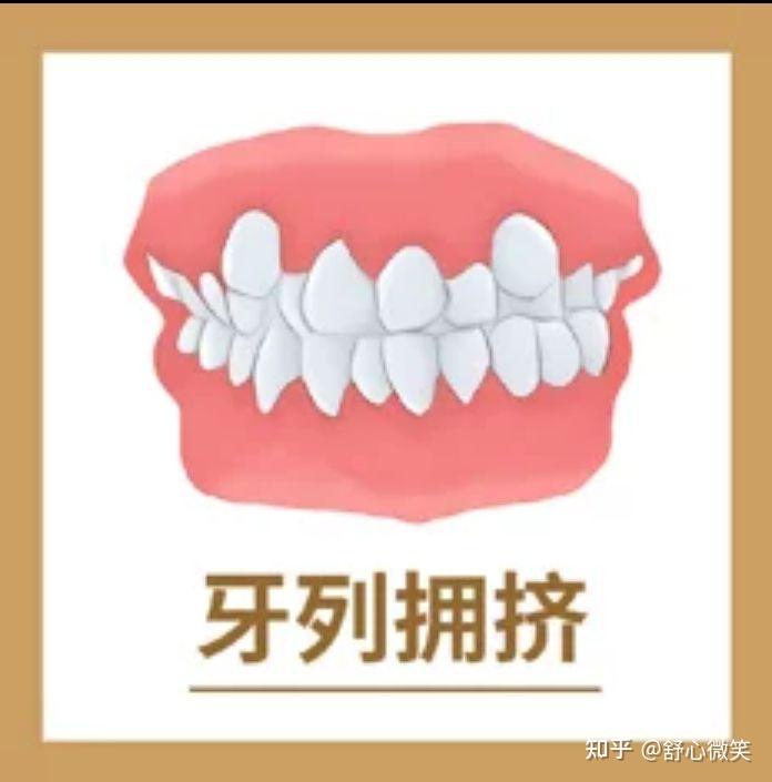 轻度的牙列拥挤需要矫正吗? - 知乎