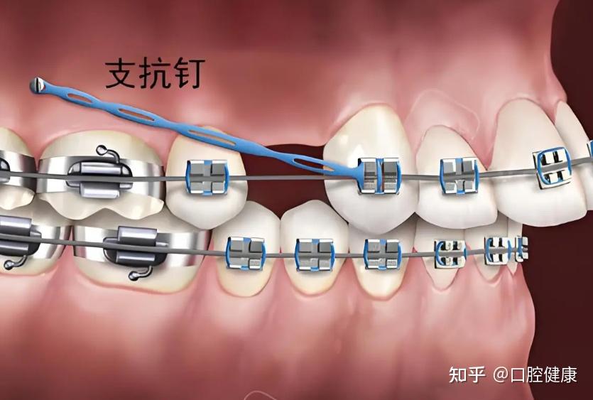 什么是支抗钉?牙齿矫正为什么要打支抗钉? - 知乎