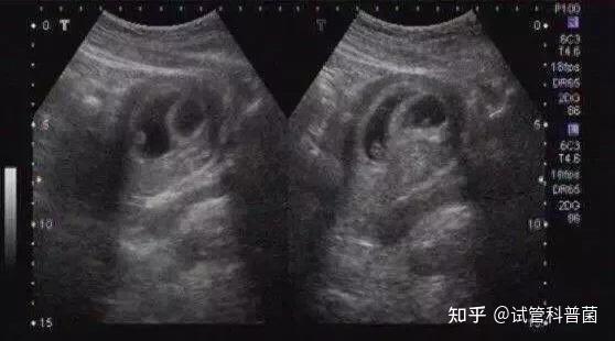 孕囊茄子状是男宝吗