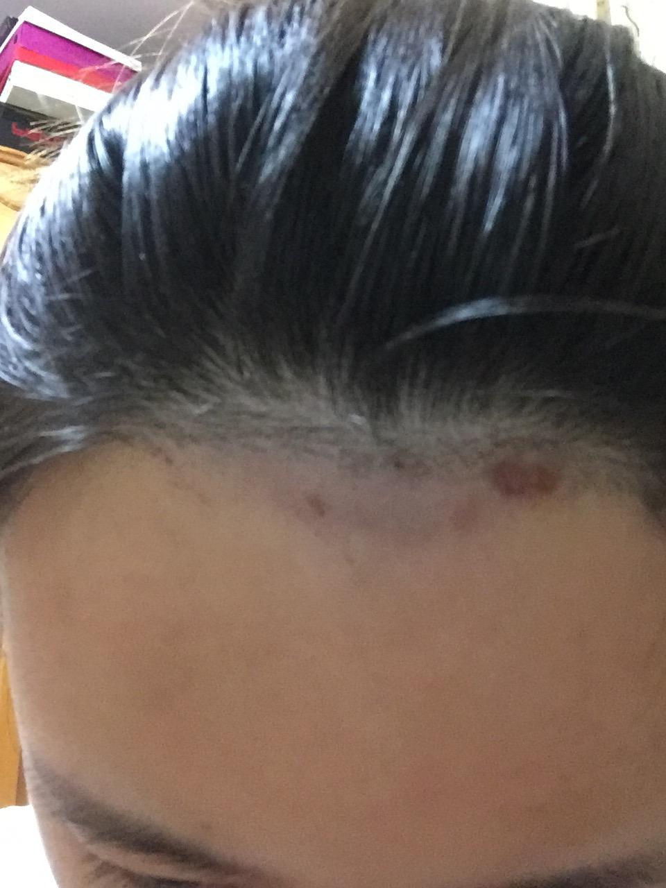 手臂做激光脱毛感觉被灼伤了,像烫伤一样的印子,一大片,请问能好吗?