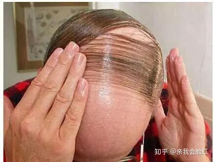 看到男生留长发更容易秃顶,是不是男生天生不适合留长发? - 知乎