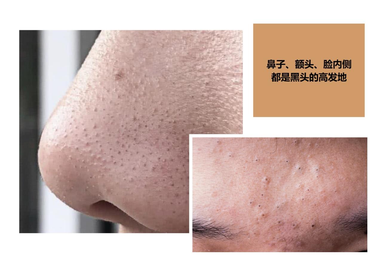 男士如何去黑头? - 知乎
