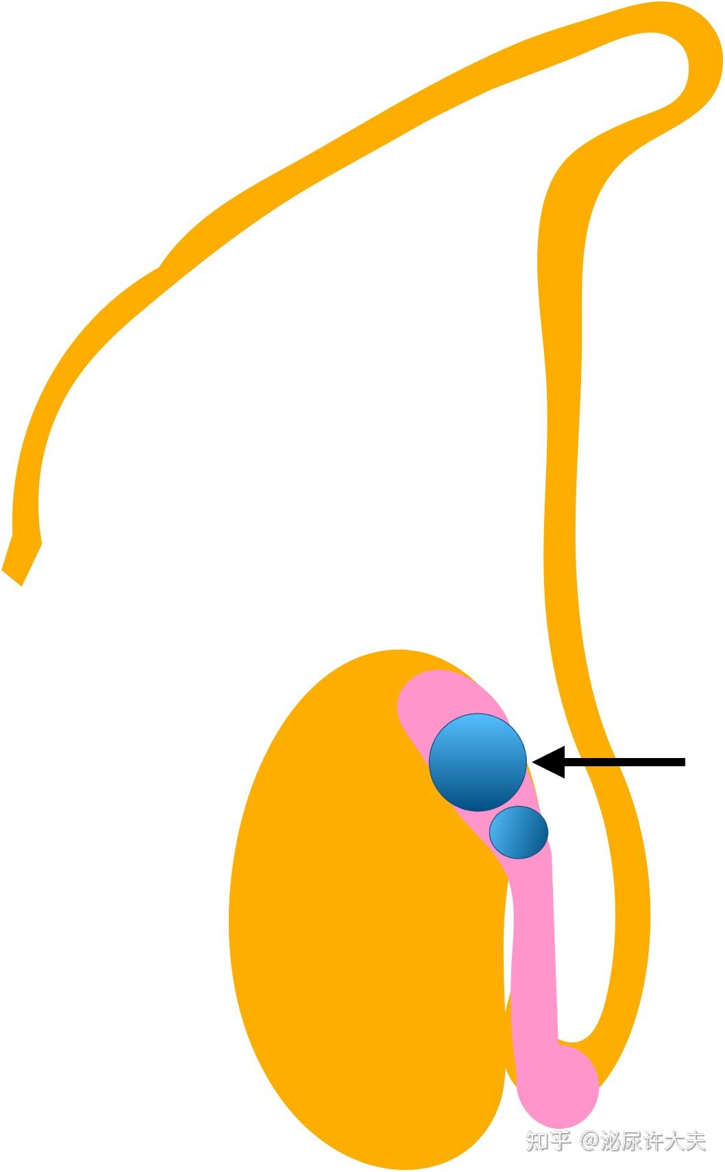 附睾头囊肿在哪里图片