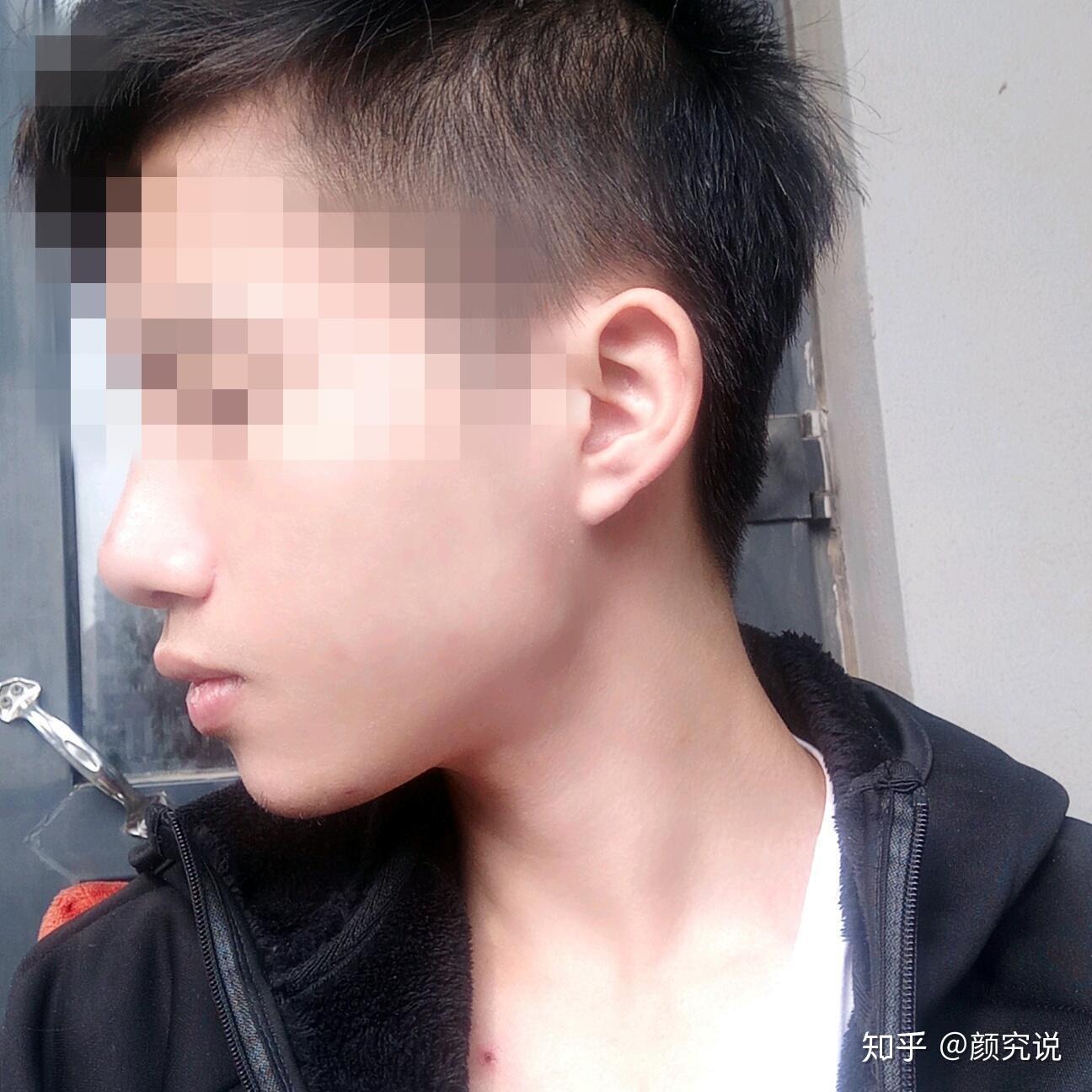 正面看很正常侧面没下巴是什么体验