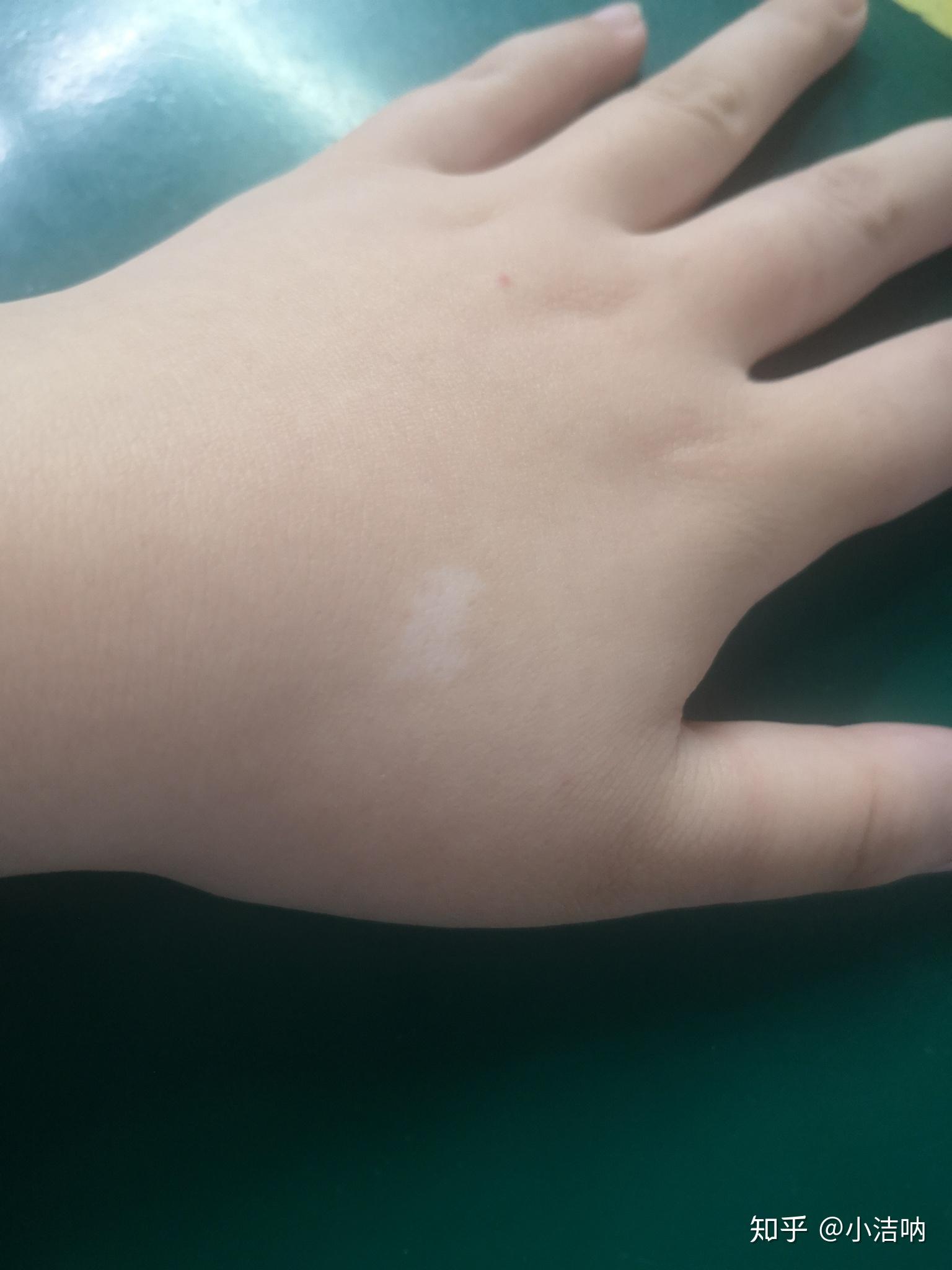 真的没有人拥有白色胎记吗