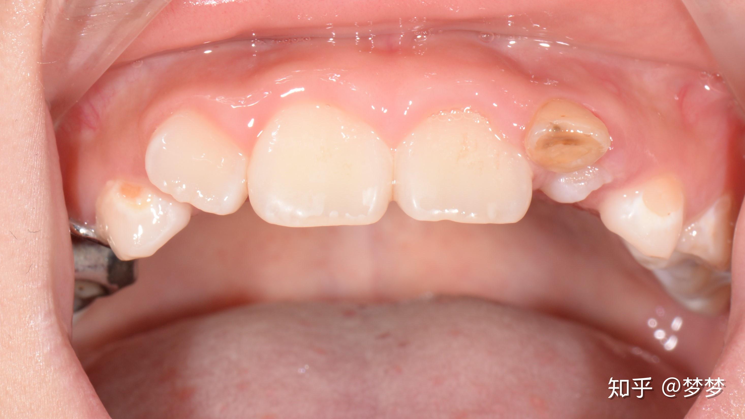 小孩六岁乳牙没有掉恒牙就冒出来了一点要注意哪些