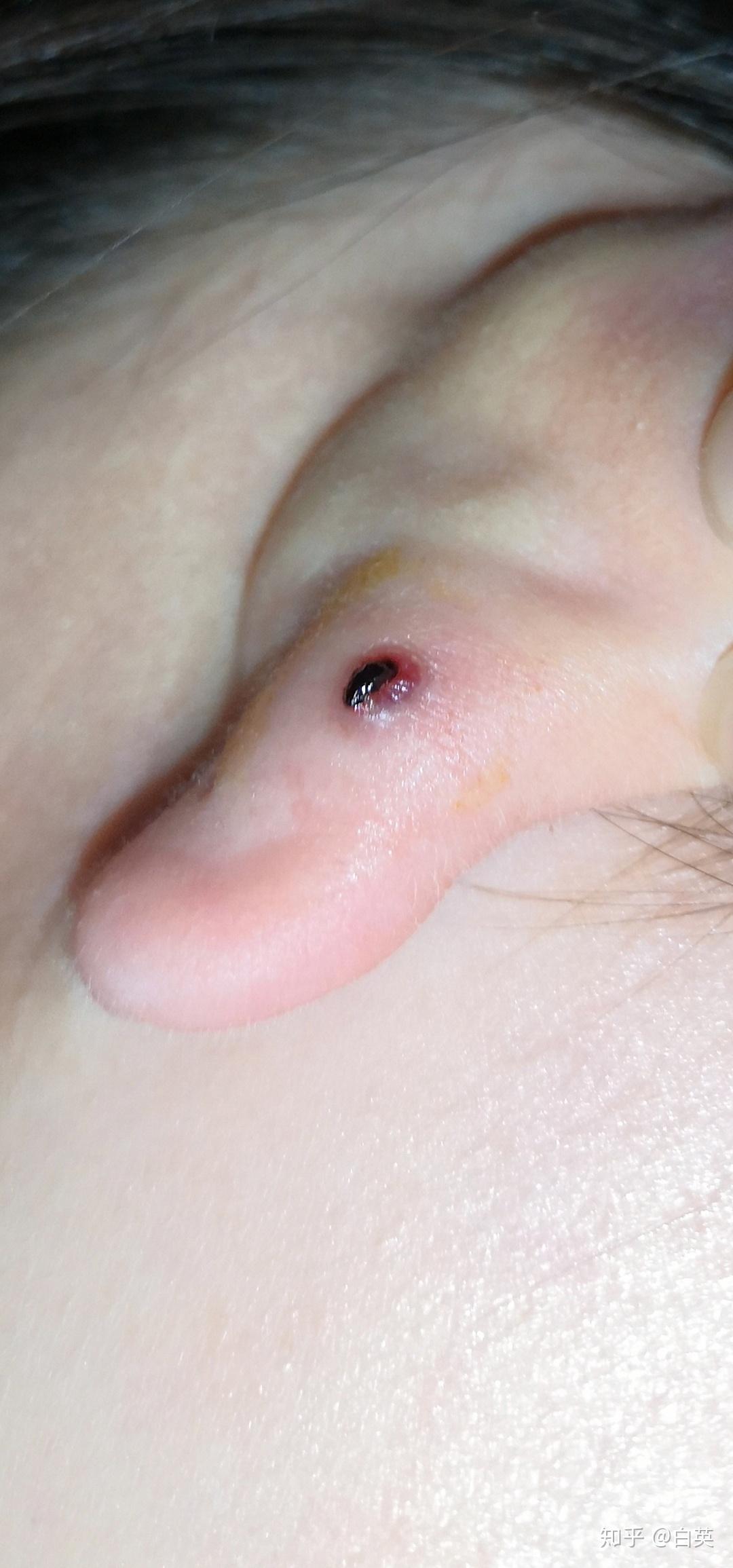 打了三个月耳洞耳洞旁边长了一个像是血包的东西不知道是什么怎么办呢