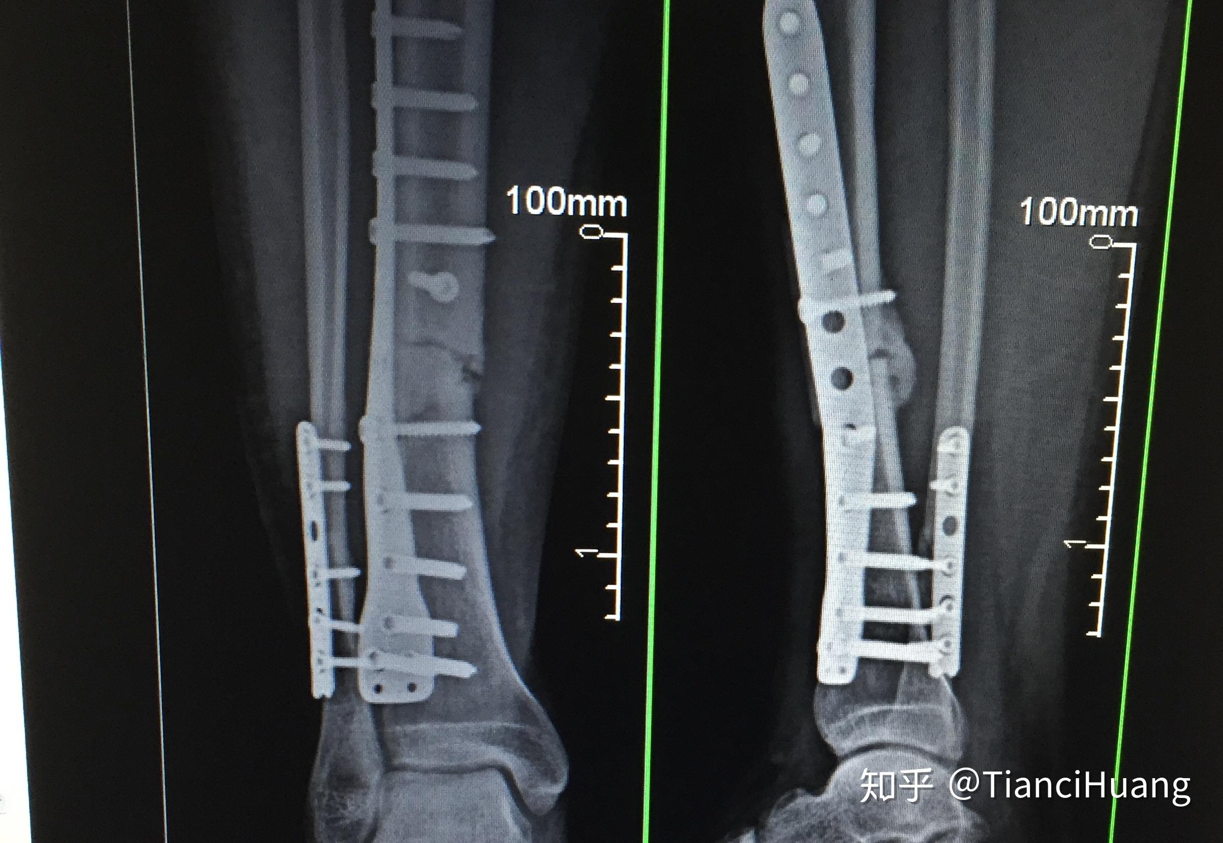 股骨颈骨折手术用三个螺丝内固定要多久能恢复走路