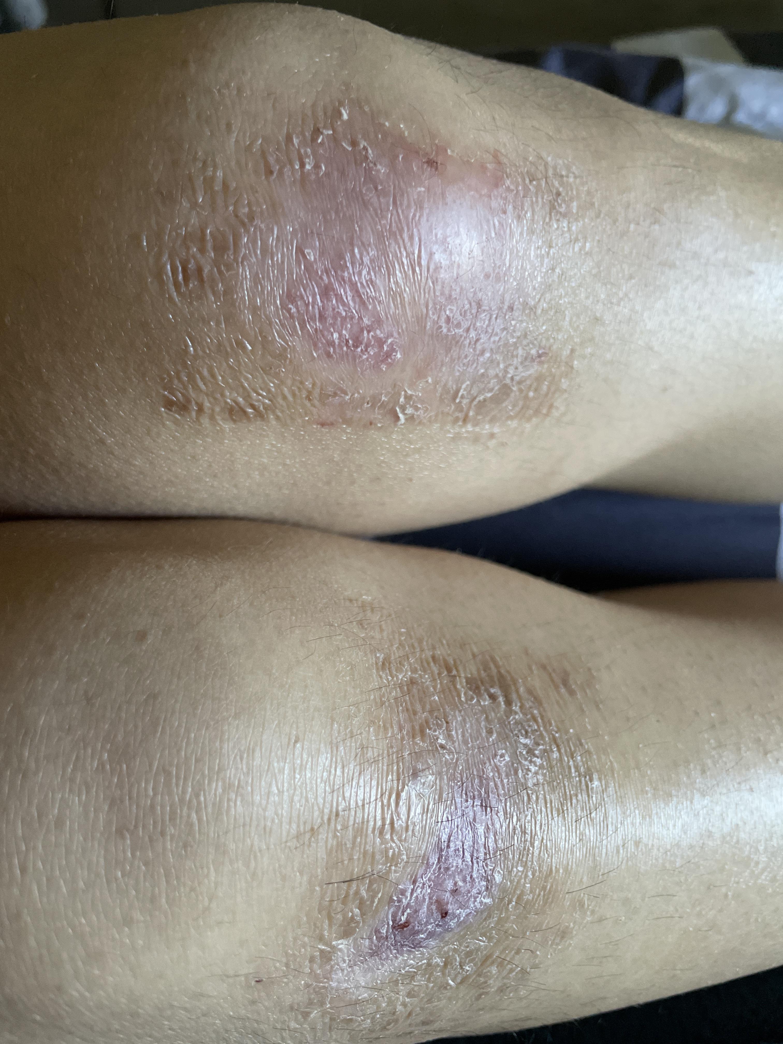 膝盖摔伤,破了一大块皮,流水,抹云南白药好了一点,三天后开始流水了