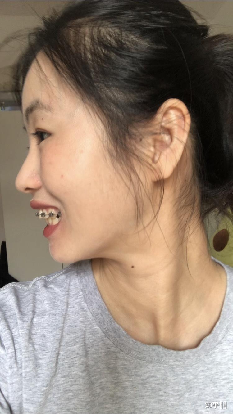 牙齿挺整齐的但是嘴凸特别是上唇正畸有用吗