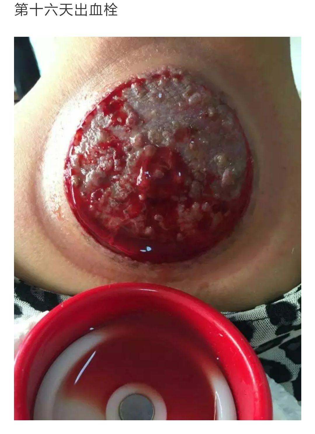 春草拔罐到底有用吗有没有副作用啊