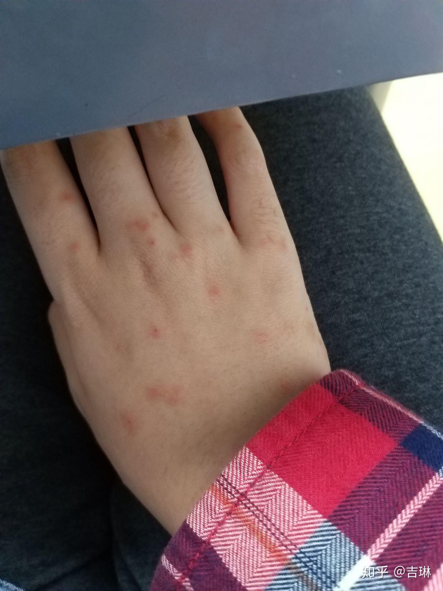 被小咬(一种黑色小飞虫)咬了痛痒难当,怎么破?