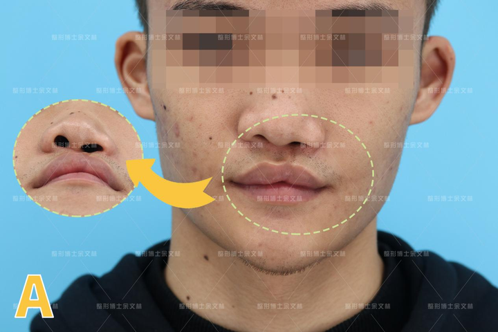 轻微兔唇会引起继发鼻畸形吗?唇裂鼻畸形要怎么修复? - 知乎