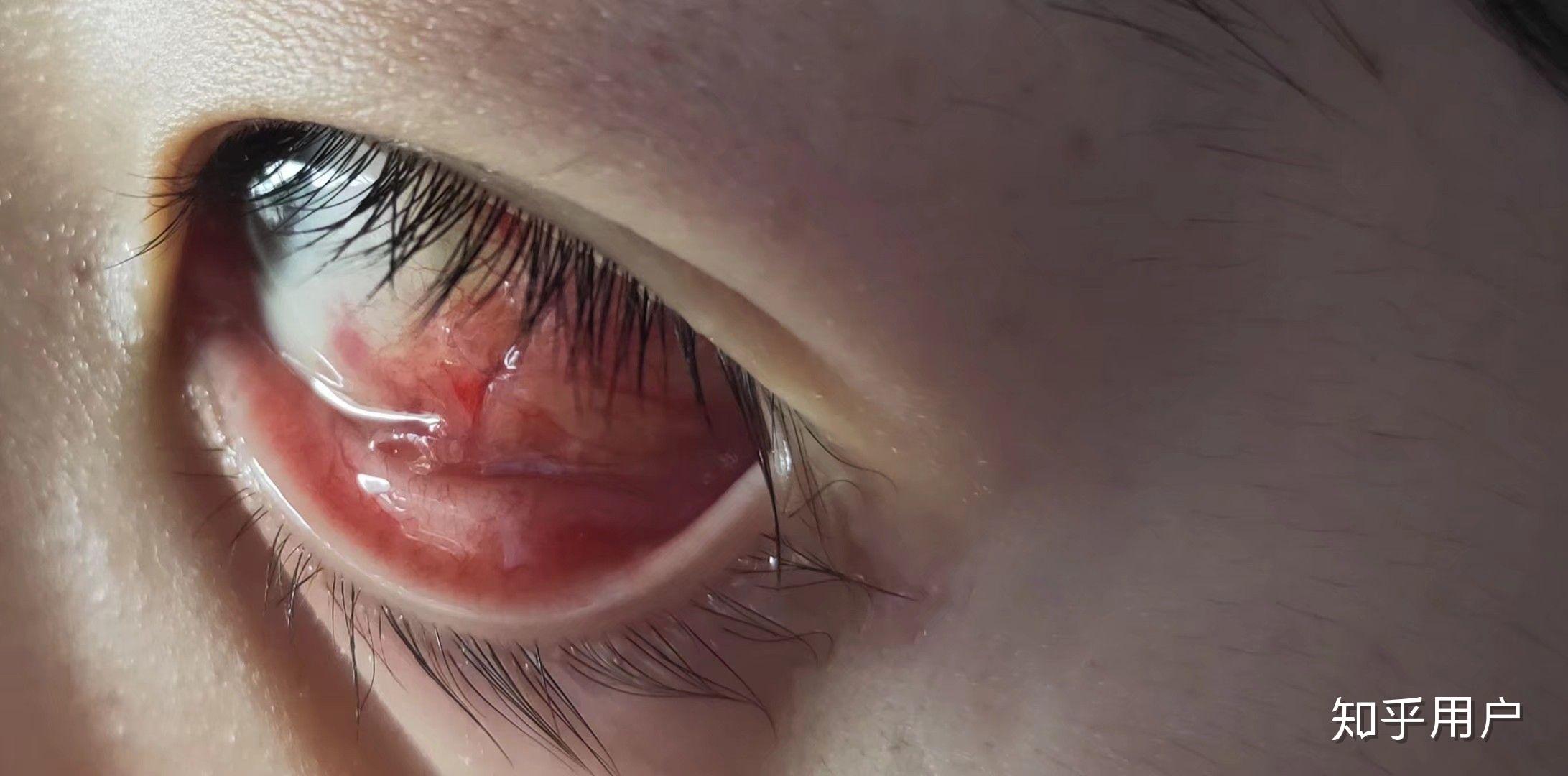 超过20岁了还能做斜视矫正手术吗?矫正后会出现哪些后遗症?