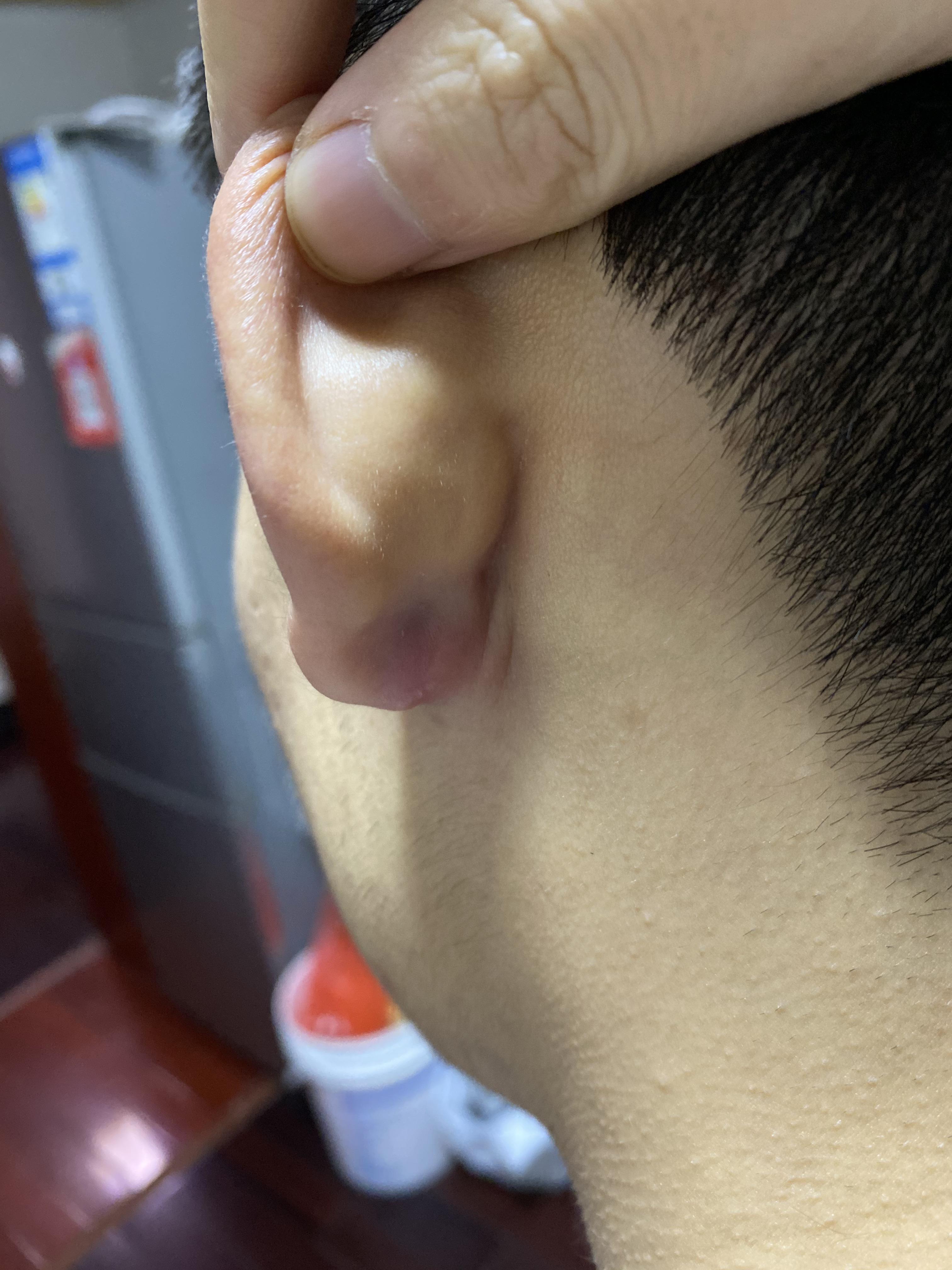 耳垂皮脂腺囊肿手术需要住院吗