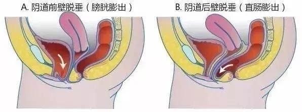 产后直肠膨出图图片