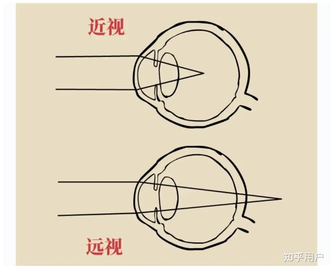 近视和远视的区别,和两者的概念是什么? - 知乎