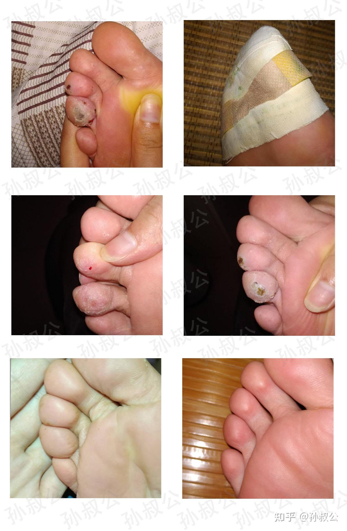 跖疣怎样有效去除