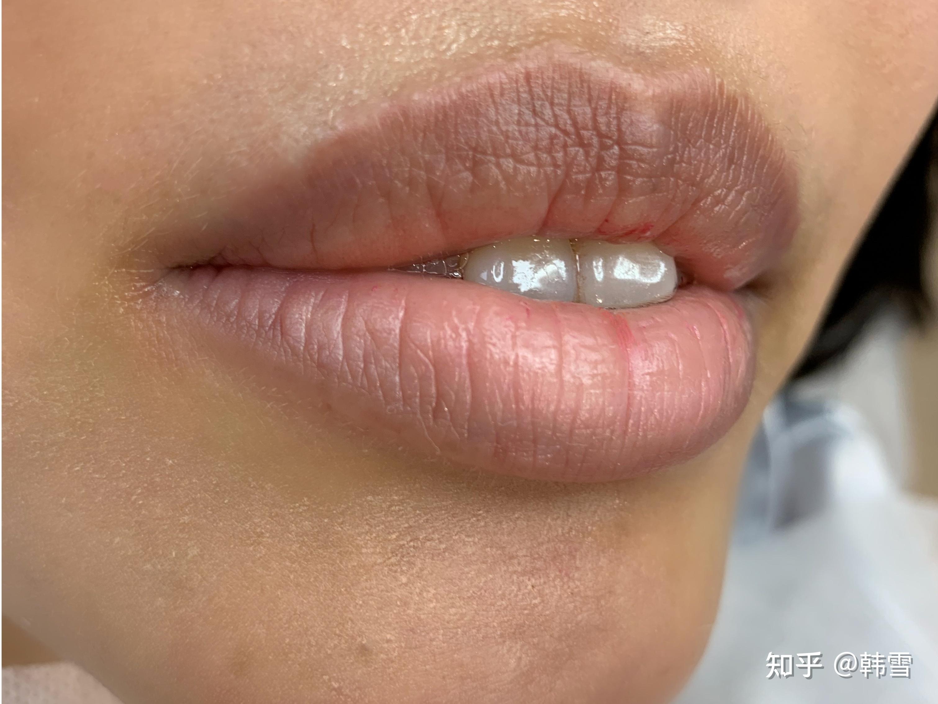 嘴唇变乌? - 知乎