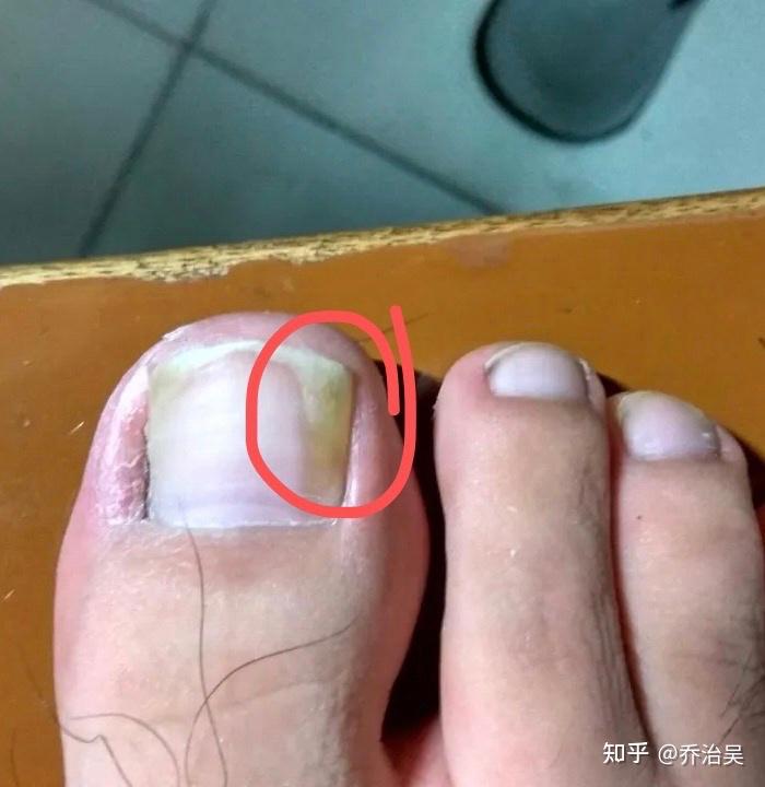 我脚趾甲右侧发黄变厚,是灰指甲吗? - 知乎