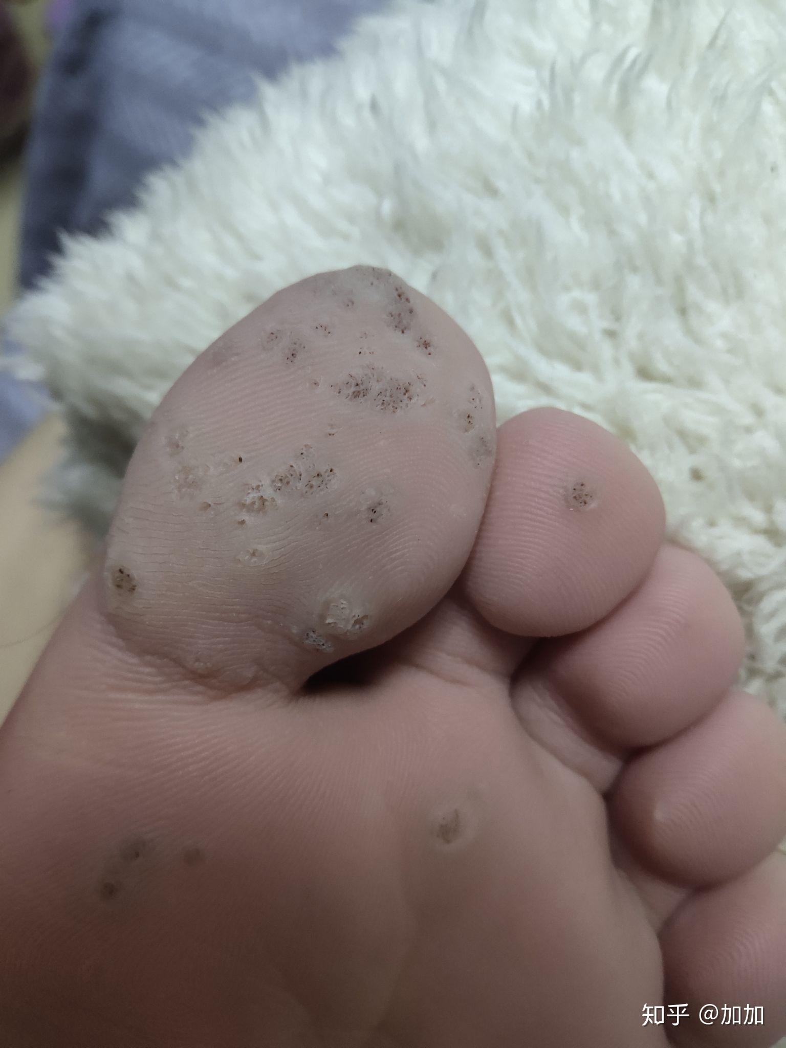 如何去除脚底上的疣