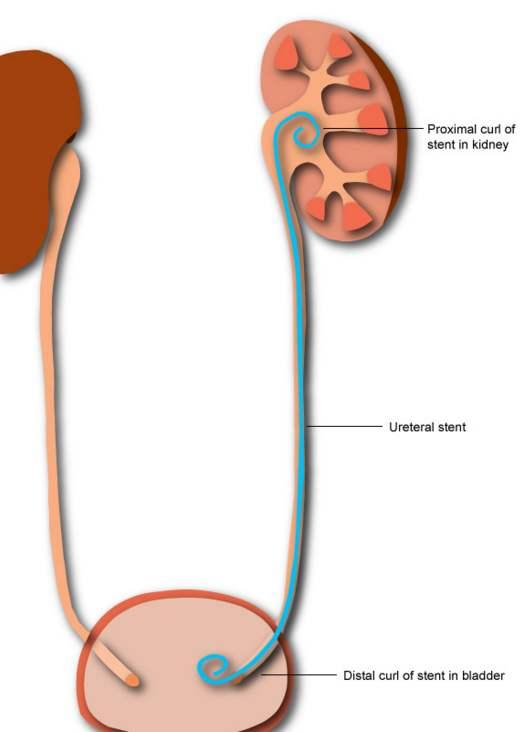 你想知道的输尿管支架