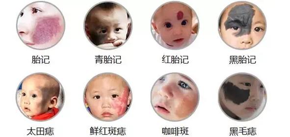 四个预防宝宝出生有胎记的小技巧 - 知乎