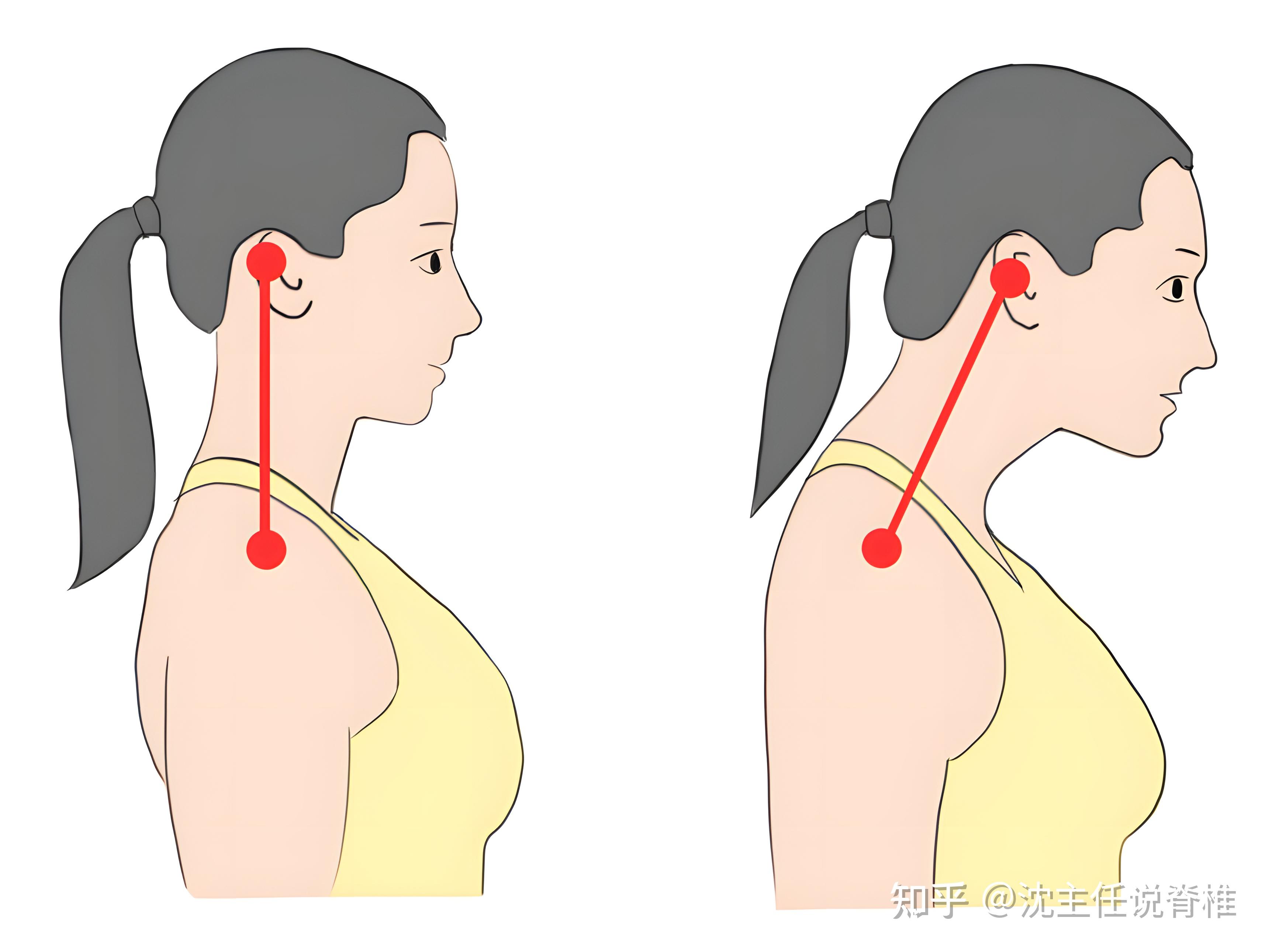 驼背脖子前倾怎么办？要多久才能矫正回来？ - 知乎