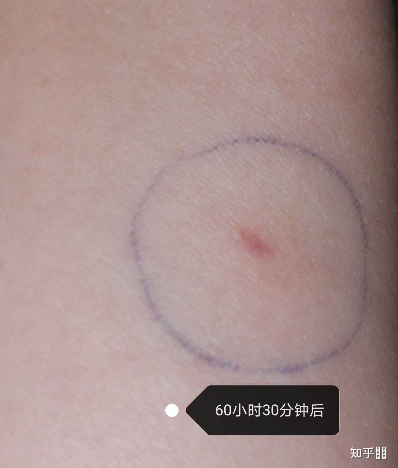 结核皮试出现如下状况是啥结果呢