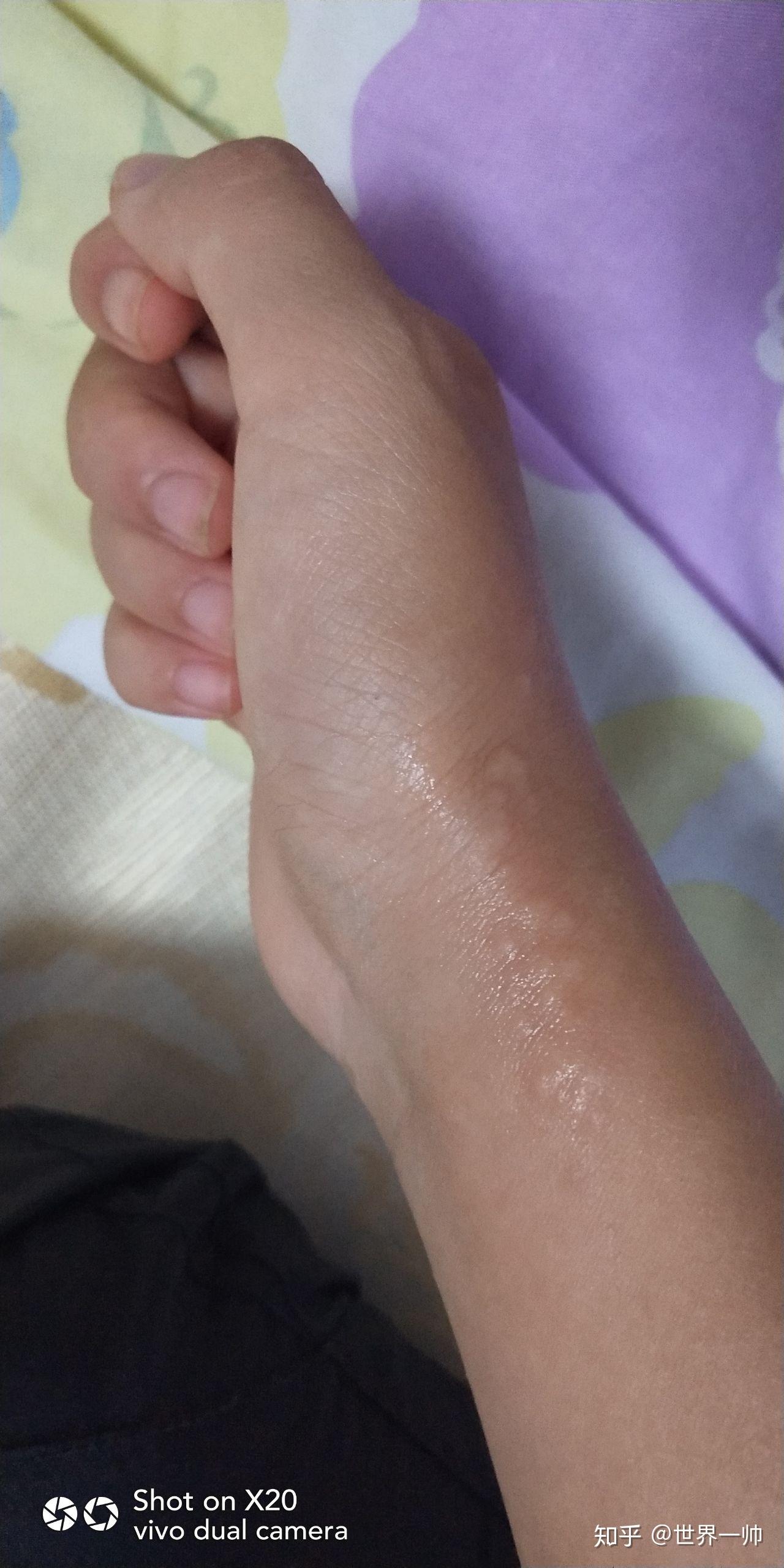 洋辣子有毒吗被蜇后怎么处理